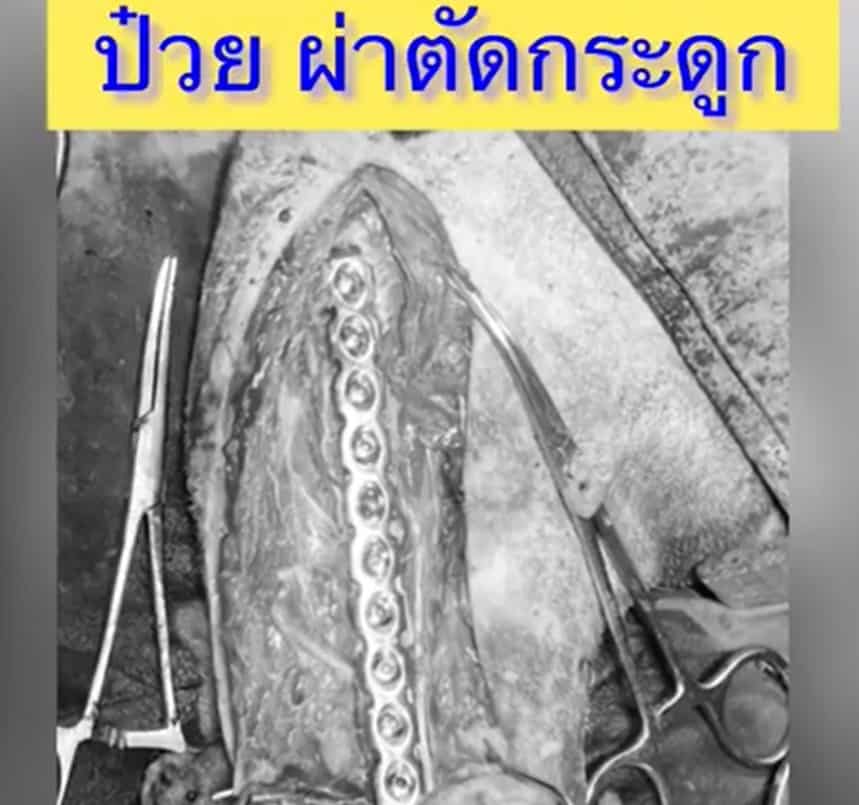 ป๋วยผ่ากระดูก1